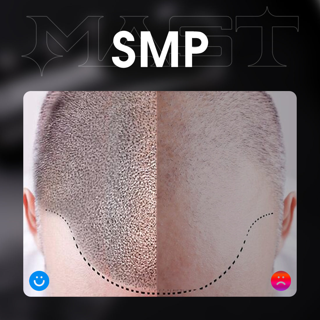 Mast Digital Scalp Micropigmentation Device SMP Kit
